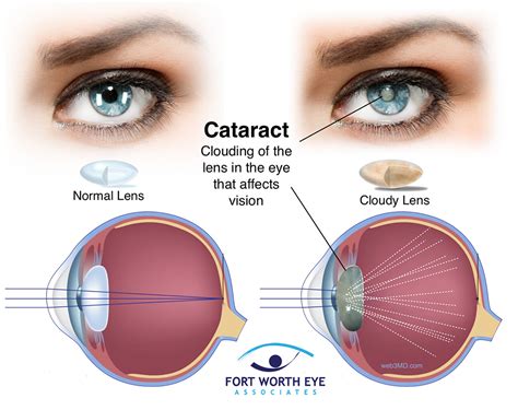 Glasses after cataract surgery: Types and who needs them.